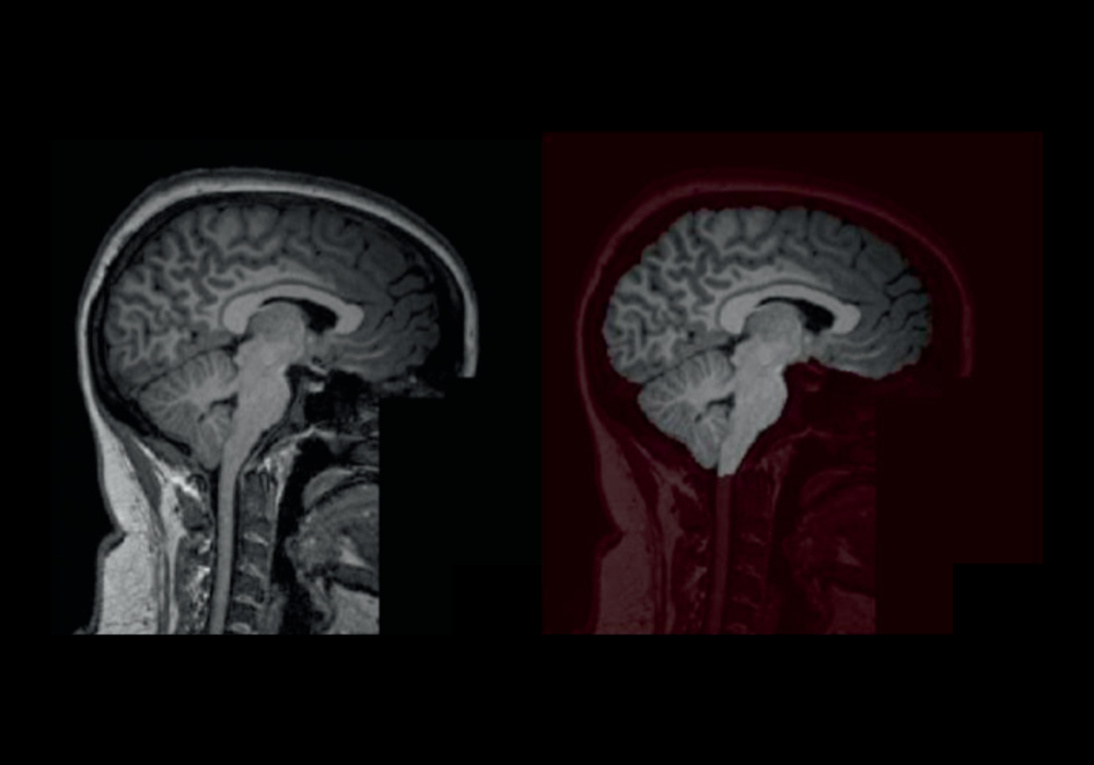 Performance evaluation of vanilla, residual, and dense 2D U-Net architectures for skull stripping of augmented 3D T1-weighted MRI head scans.